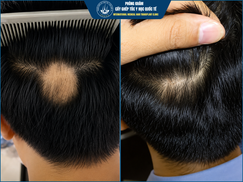 Ưu điểm của cấy tóc trên vùng sẹo