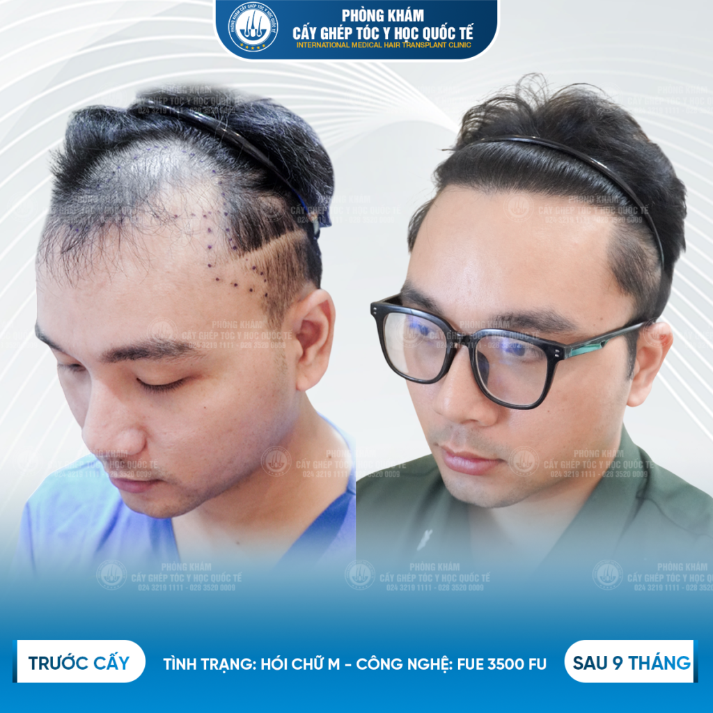 Vì sao phải kiêng ăn sau cấy tóc? 