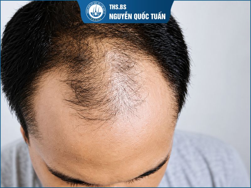  Vì sao đàn ông bị hói chữ M? 