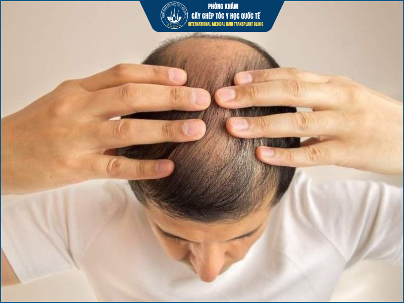 Vì sao tóc sau cấy không mọc ngay?