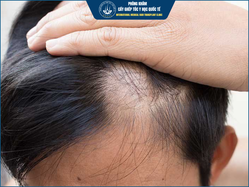 Vì sao tóc không thể mọc lại trên vùng sẹo?