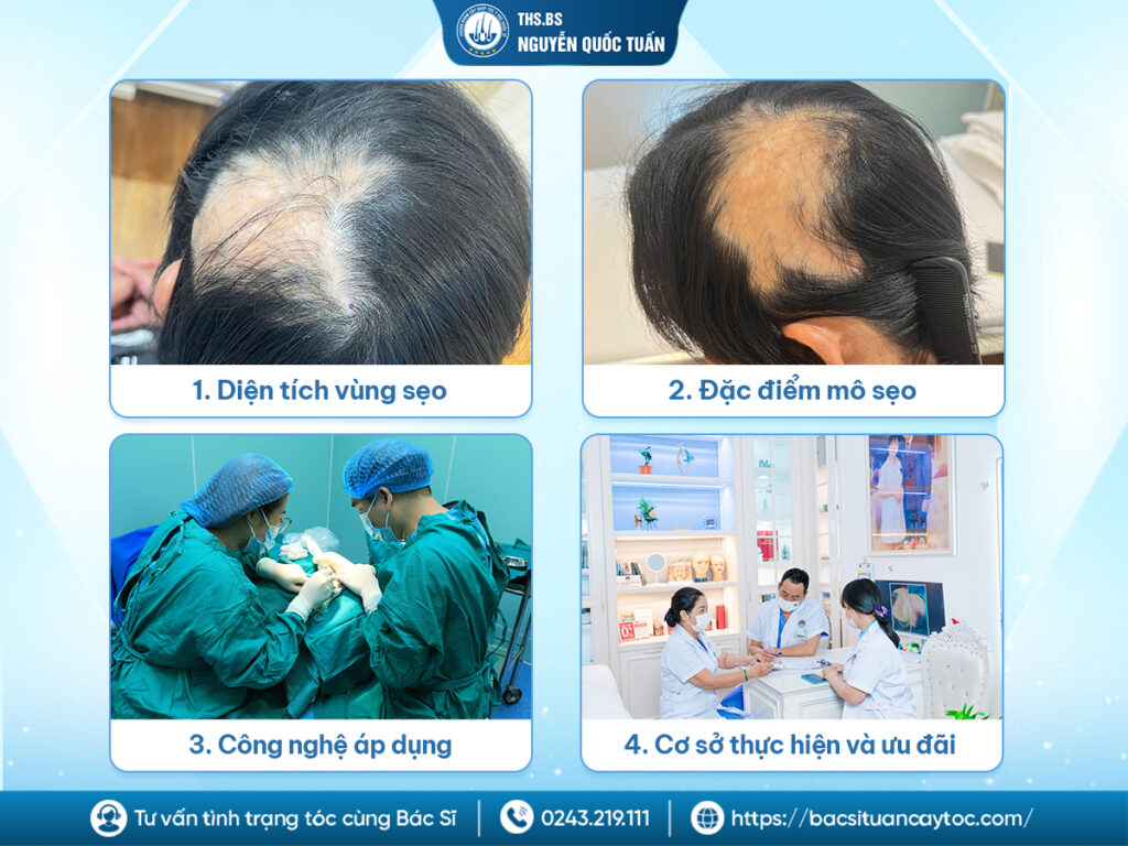  Những yếu tố quyết định tới chi phí cấy tóc trên sẹo 