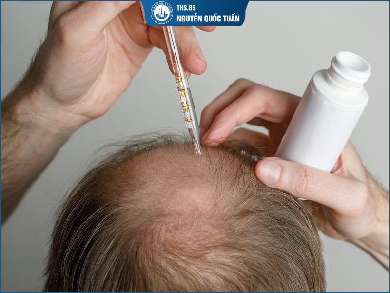 Chỉ dùng Minoxidil có giúp hết hói đầu không? 