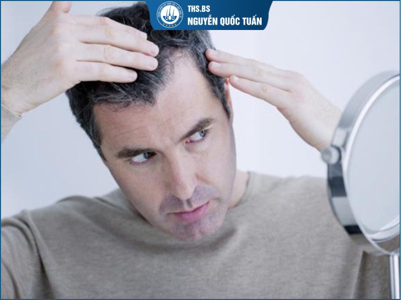  Biểu hiện hói chữ M thường xuất hiện đầu tiên ở đâu? 