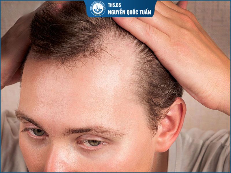  biểu hiện hói chữ M giúp bạn tự nhận biết sớm  