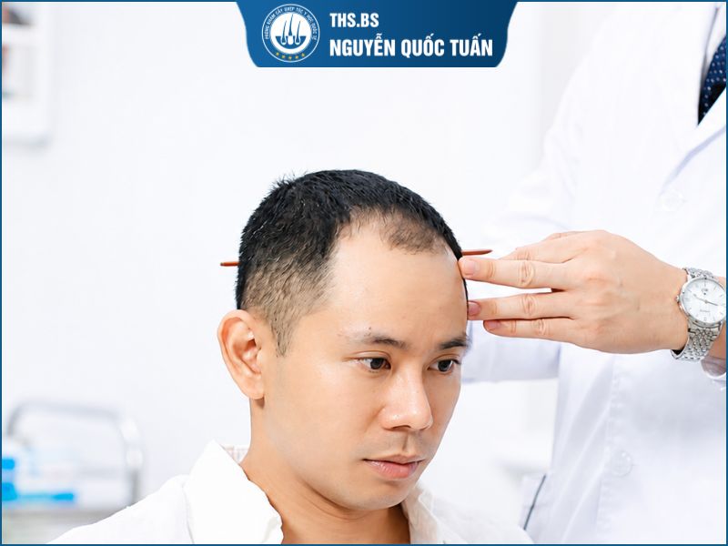 Lý do ca sĩ Lê Bảo Bình quyết định cấy tóc 