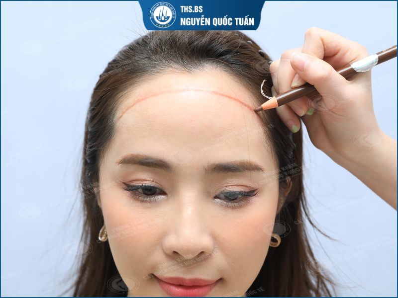 Những tiêu chí cần biết trước khi làm đường chân tóc