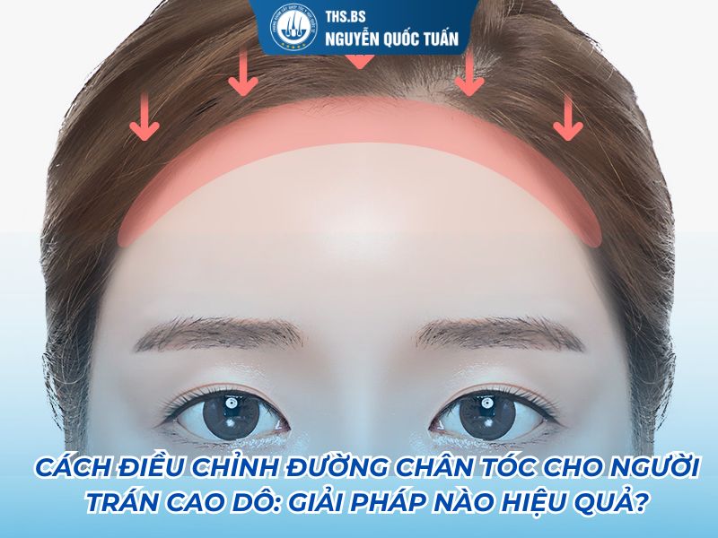 cách điều chỉnh đường chân tóc cho người trán cao dô