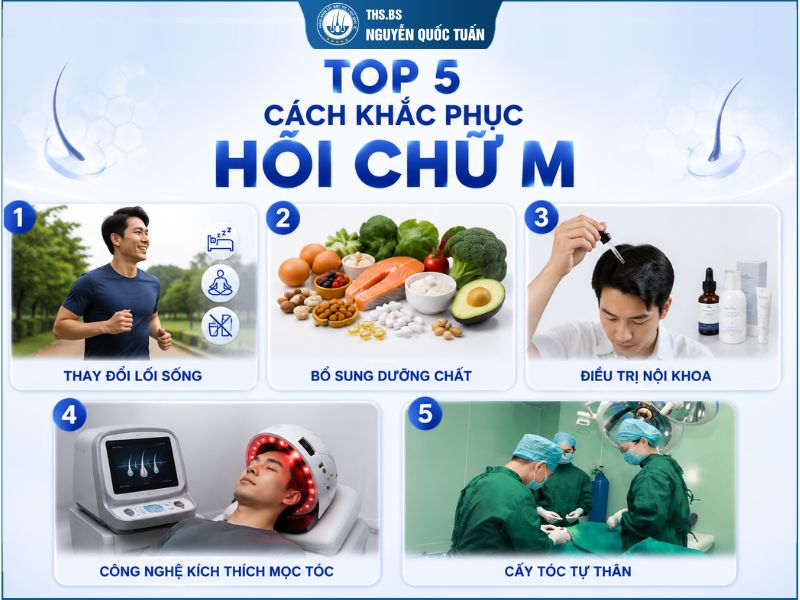 Cách khắc phục hói chữ M được áp dụng hiện nay 
