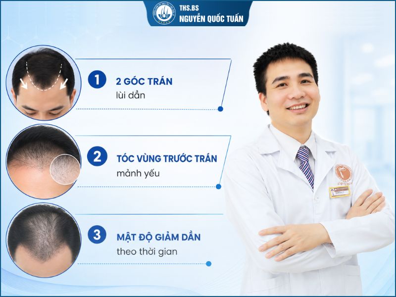 Cách nhận biết hói chữ M thông qua các dấu hiệu điển hình