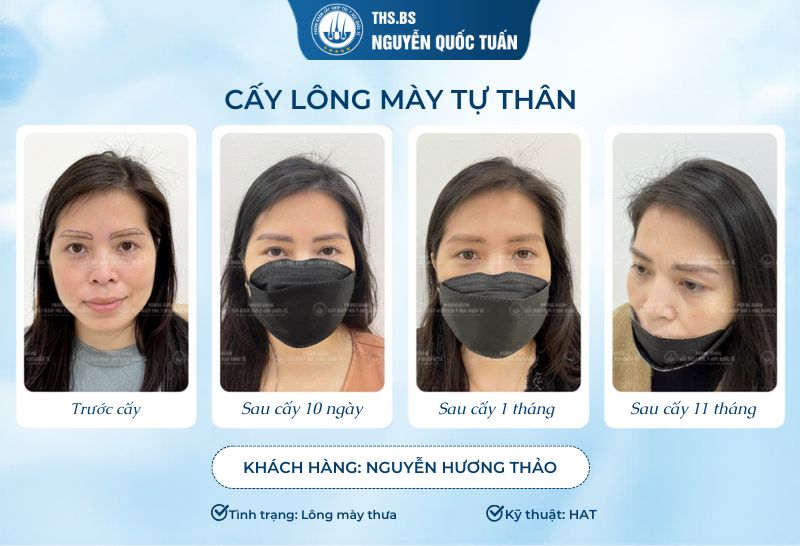 Hiệu quả thực tế sau cấy tóc của khách hàng  
