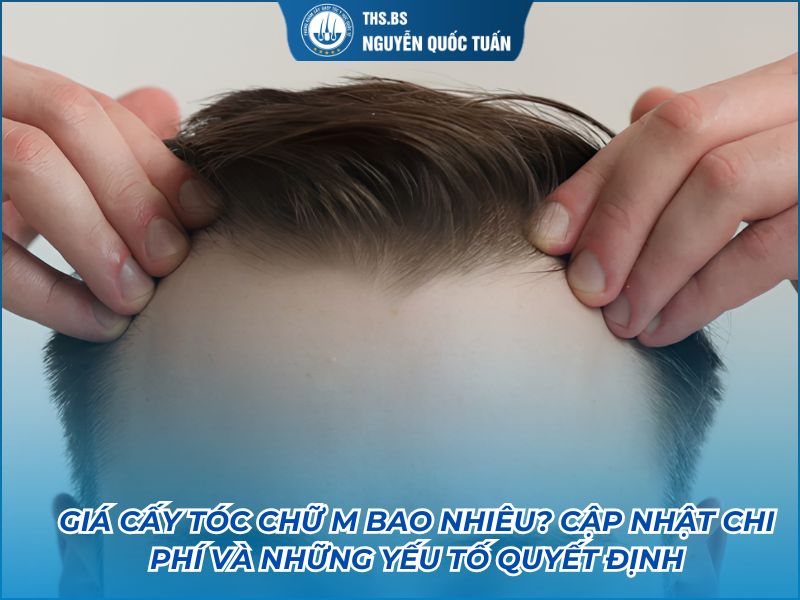 cấy tóc chữ M giá bao nhiêu