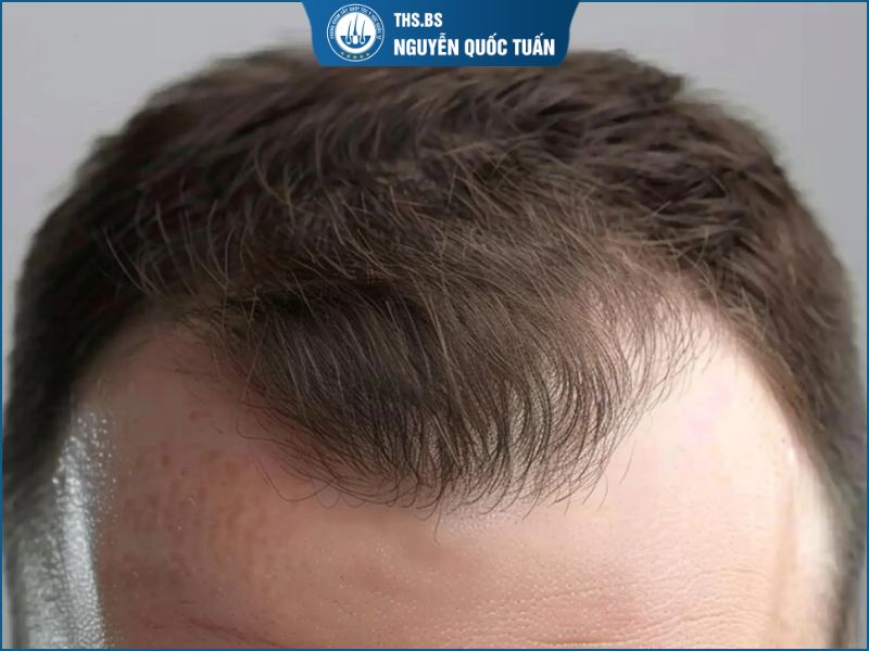 Giá cấy tóc trán chữ M được tính như thế nào?  