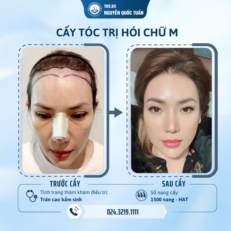 Hiệu quả cấy tóc tại Phòng Khám Cấy Tóc Y Học Quốc Tế  
