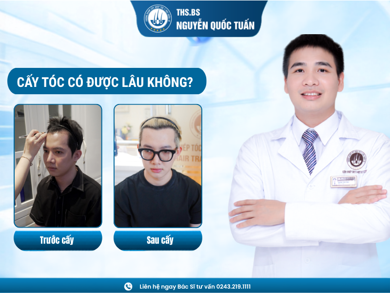 cấy tóc có được lâu không