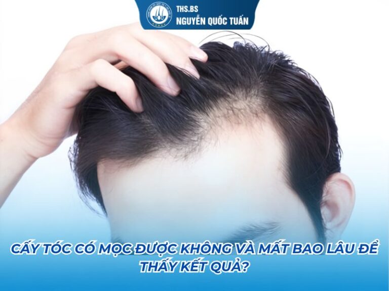 cấy tóc có mọc được không