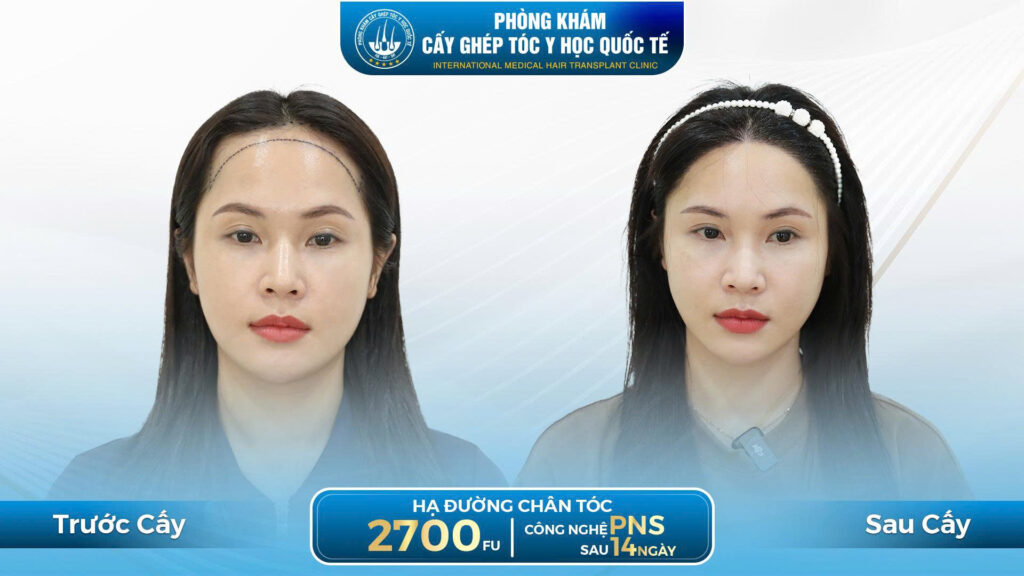 Kết quả cấy tóc sau 14 ngày kĩ thuật PNS 