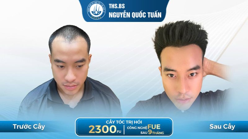 Cấy tóc khi vùng hói đã mất khả năng mọc lại 