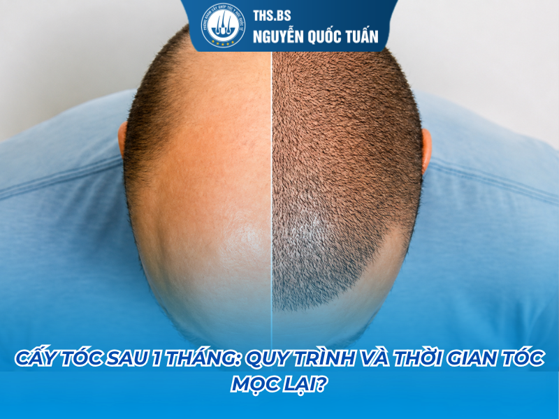 cấy tóc sau 1 tháng