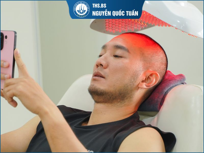 Cấy tóc sau 1 tuần có bị rụng không?