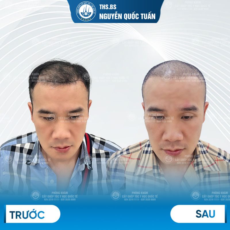 Kết quả cấy tóc sau 1 tuần