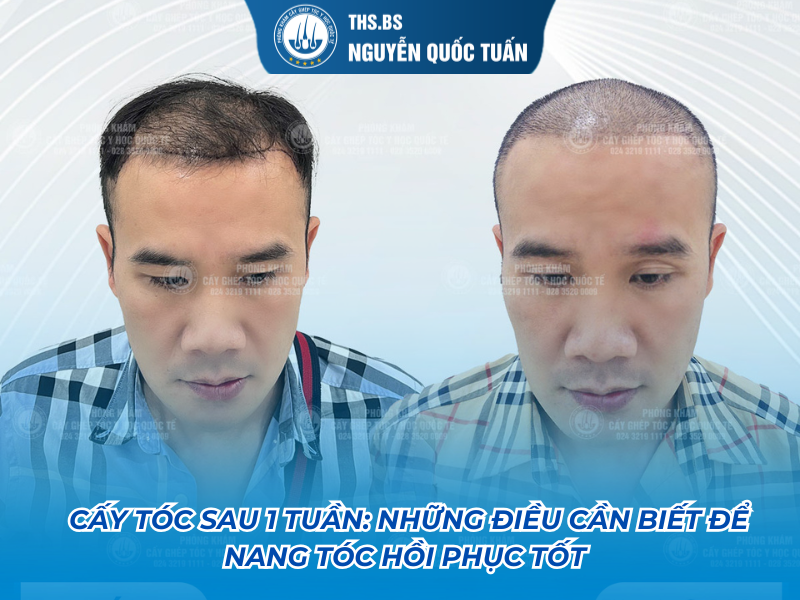 cấy tóc sau 1 tuần