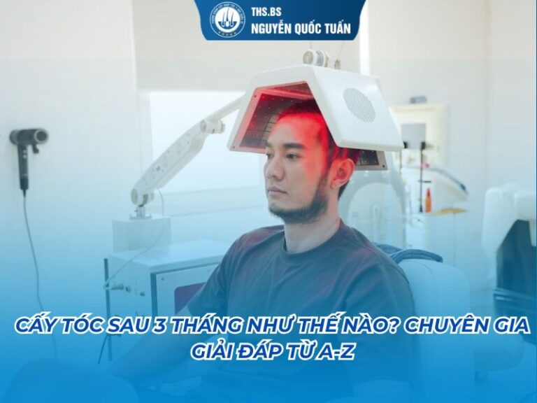 cấy tóc sau 3 tháng như thế nào