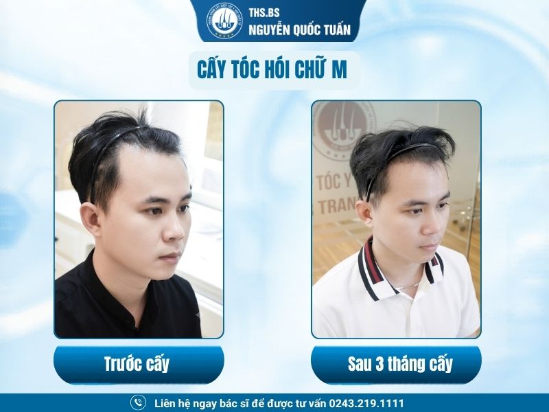 Kết quả cấy tóc sau 3 tháng  