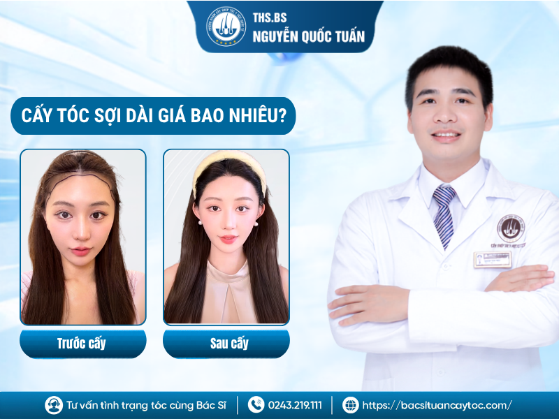 cấy tóc sợi dài giá bao nhiêu