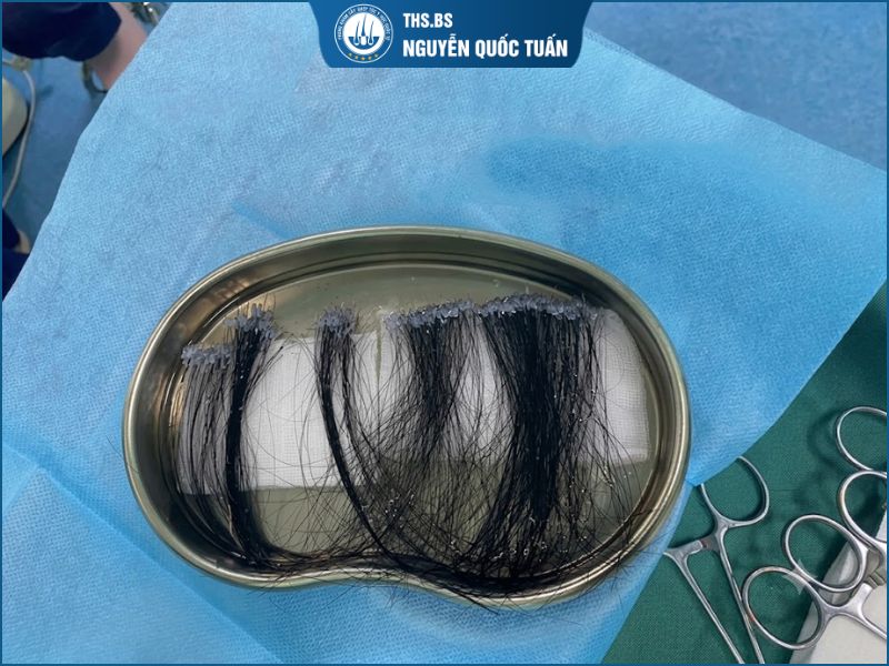 Cấy tóc sợi dài - Bước tiến mới trong lĩnh vực phục hồi tóc hiện đại 