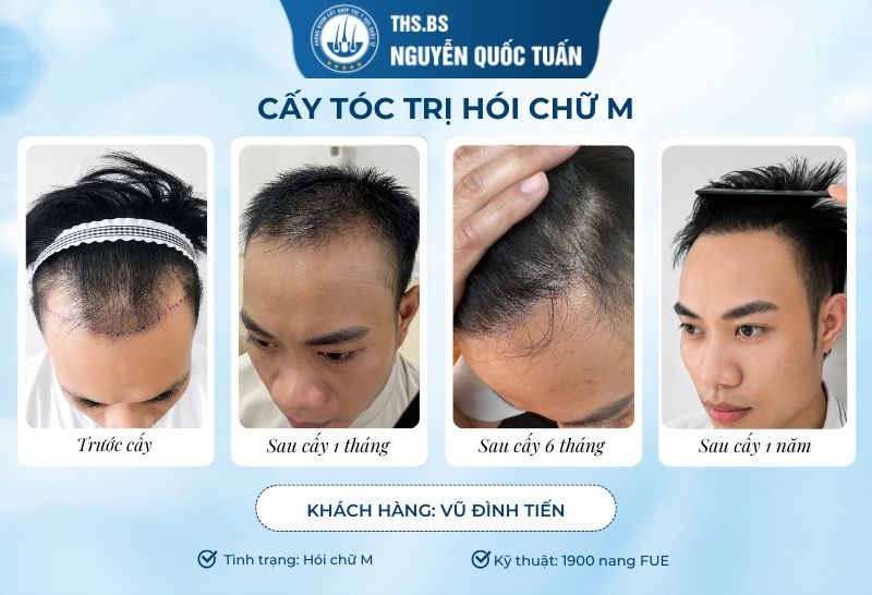 Kết quả cấy tóc trị hói chữ m sau 1 năm
