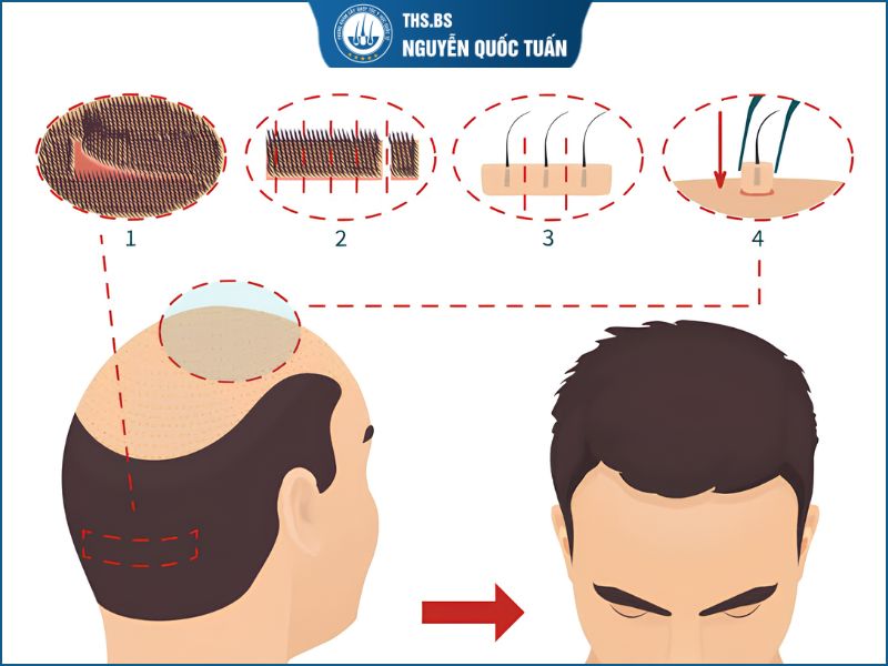 Cấy tóc tự thân là gì? 