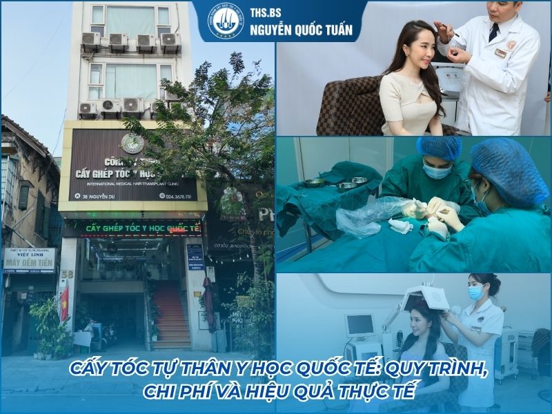 cấy tóc tự thân y học quốc tế