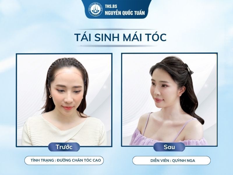 Các cách điều chỉnh đường chân tóc phổ biến hiện nay