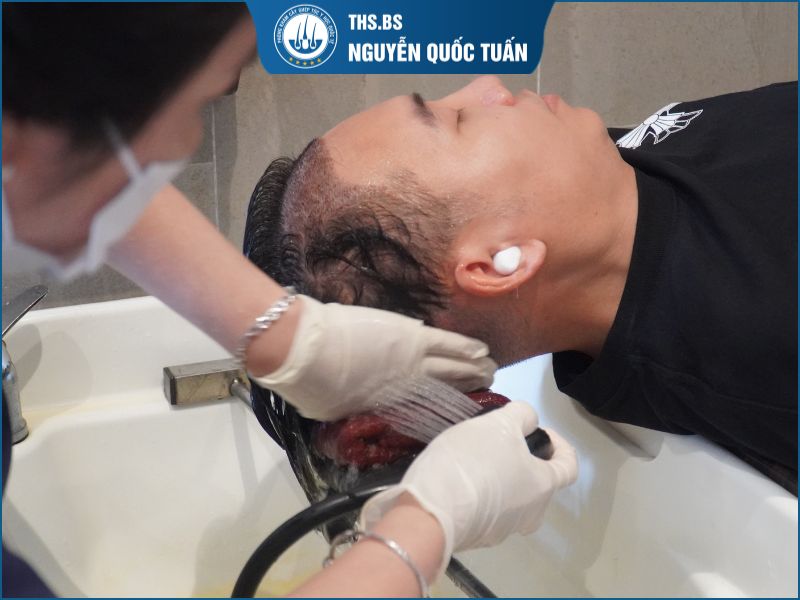 Gội đầu chăm sóc tóc sau cấy 