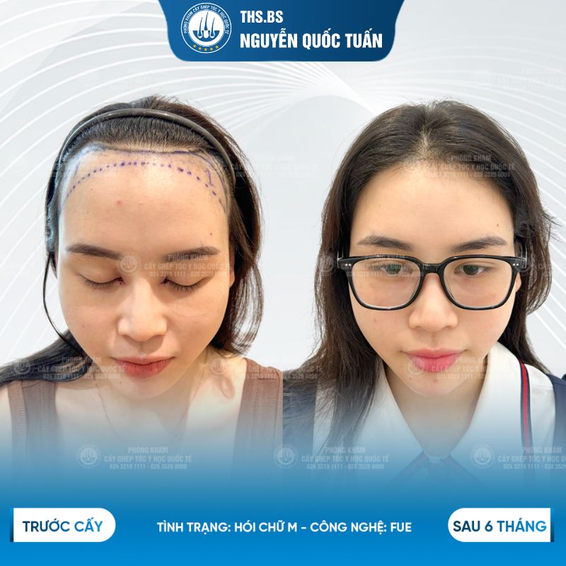 Hiệu quả cấy tóc chữ M  