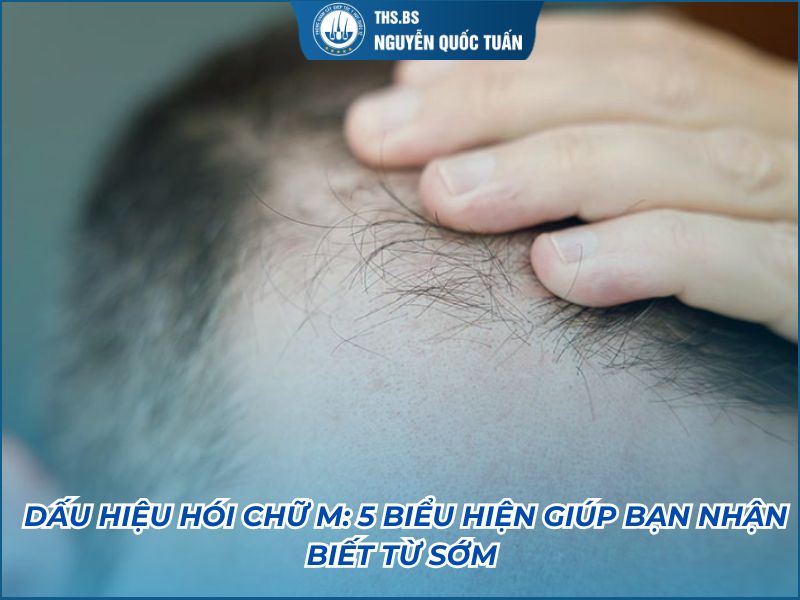 dấu hiệu hói chữ m
