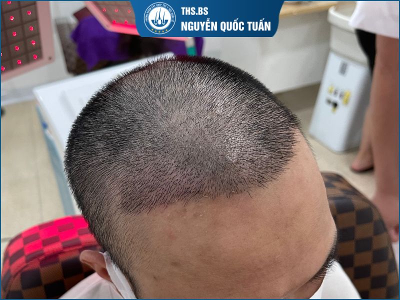 Dấu hiệu hồi phục bình thường và không cần quá lo lắng