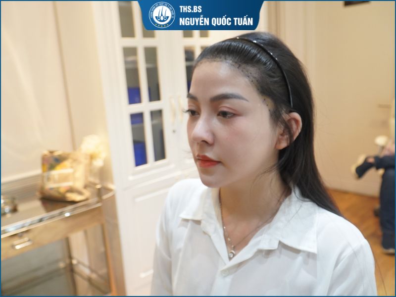  Mức độ hói và số lượng nang tóc cần cấy 