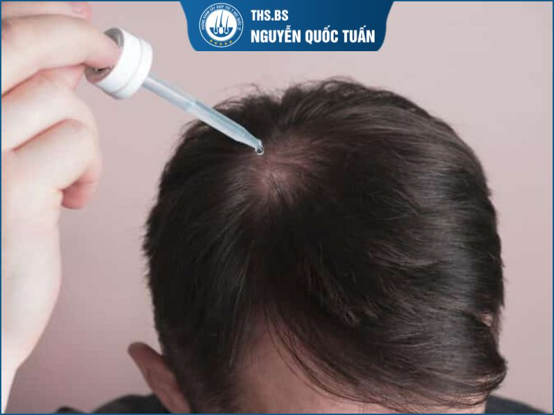 Điều trị hói đầu di truyền bằng thuốc