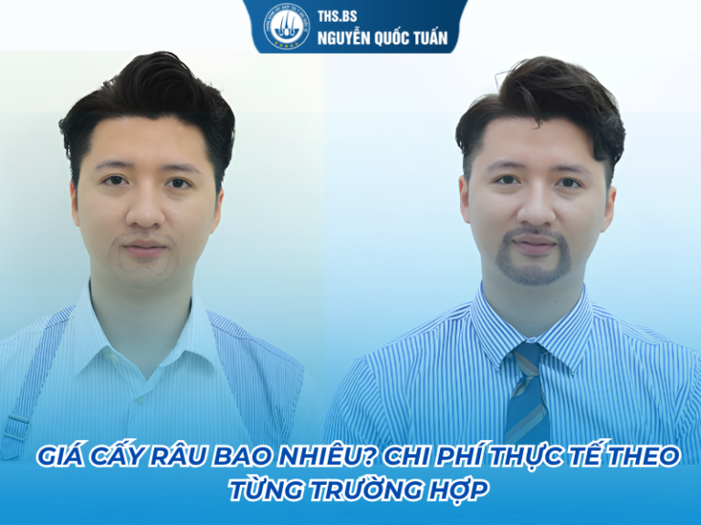 giá cấy râu bao nhiêu