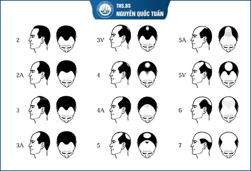 Mức độ hói theo thang Norwood