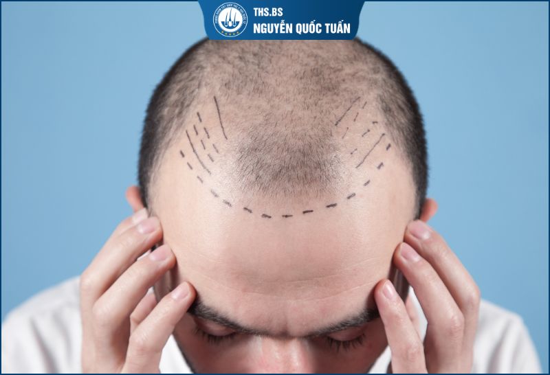Giá cấy tóc nam bao nhiêu tiền? Khoảng chi phí thực tế hiện nay