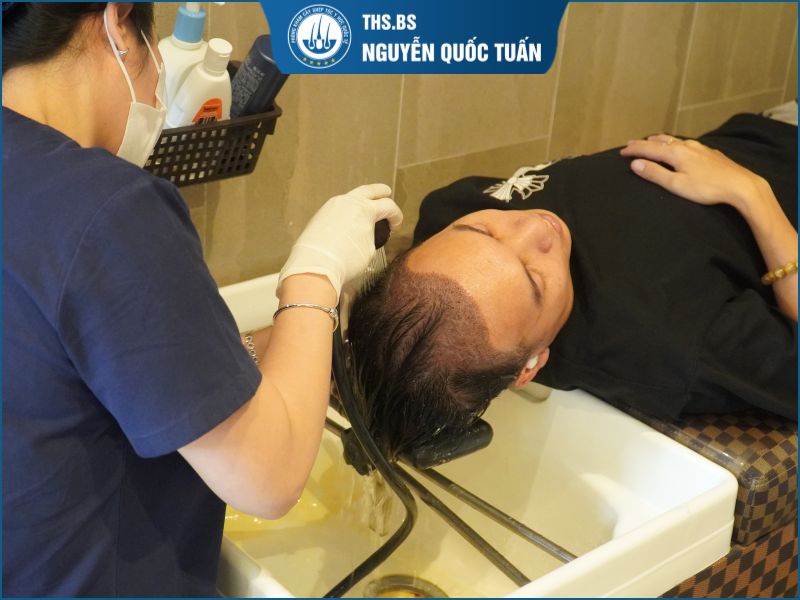 Quy trình chăm sóc sau 1 tuần cấy tóc