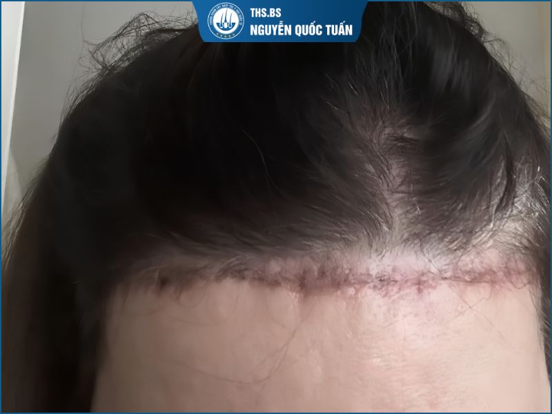 Trải nghiệm thực tế từ khách hàng sau khi tái định hình đường chân tóc