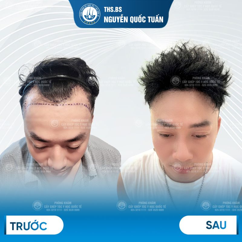 Kết quả cấy tóc tại Phòng Khám Cấy Tóc Y Học Quốc Tế