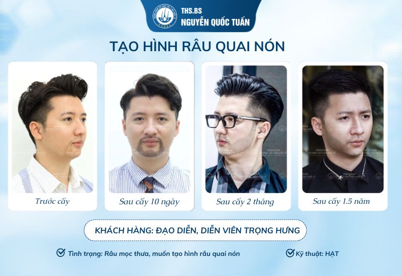 Kết quả của cấy râu sau 1, 5 năm của đạo diễn Trọng Hưng 