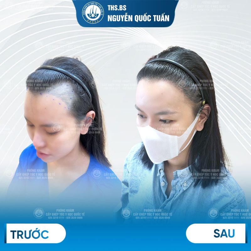 Kết quả cấy tóc tại Phòng Khám Cấy Tóc Y Học Quốc Tế 