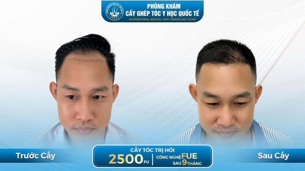 Kết quả cấy tóc sau 9 tháng kĩ thuật FUE  