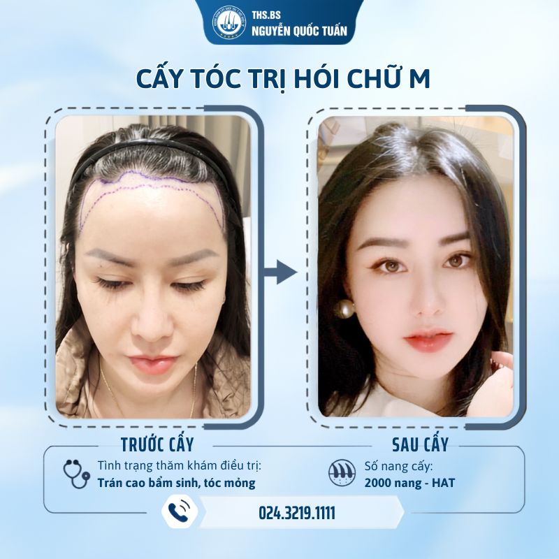 Tóc mỏng có cấy tóc được không? Chuyên gia giải đáp 